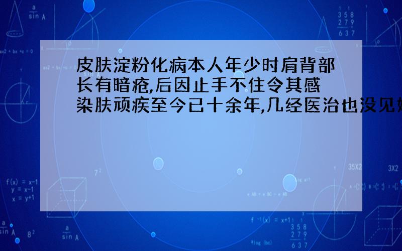 皮肤淀粉化病本人年少时肩背部长有暗疮,后因止手不住令其感染肤顽疾至今已十余年,几经医治也没见好转,得出检查结果是皮肤组织